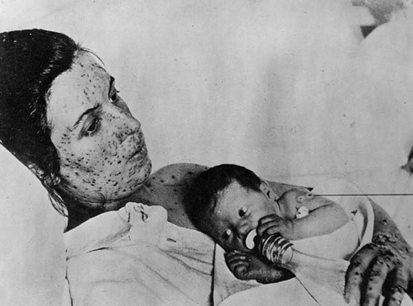 Smallpox mother with her child