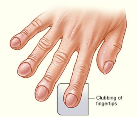 Finger Clubbing